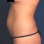 VASER Hi Def Liposuction Before & After Patient #5202