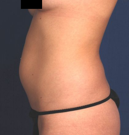 VASER Hi Def Liposuction Before & After Patient #5202