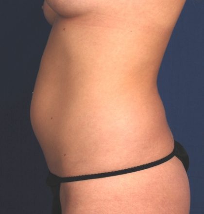 VASER Hi Def Liposuction Before & After Patient #5202