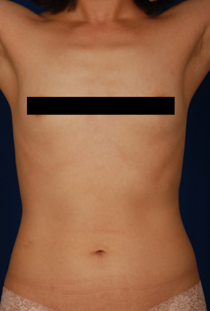 VASER Hi Def Liposuction Before & After Patient #5283