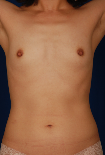 VASER Hi Def Liposuction Before & After Patient #5283