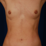 Breast Fat Transfer Before & After Patient #5283