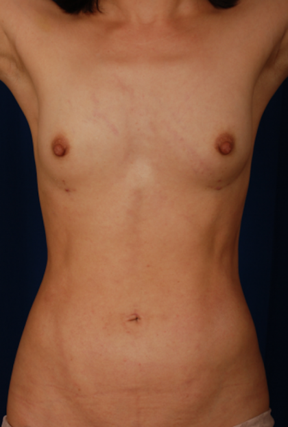 VASER Hi Def Liposuction Before & After Patient #5283