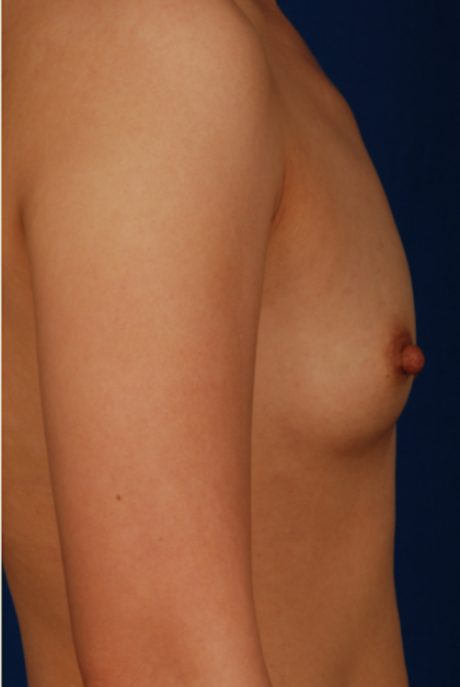 Breast Fat Transfer Before & After Patient #5290