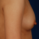 Breast Fat Transfer Before & After Patient #5290