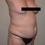 Standard Liposuction Before & After Patient #5328