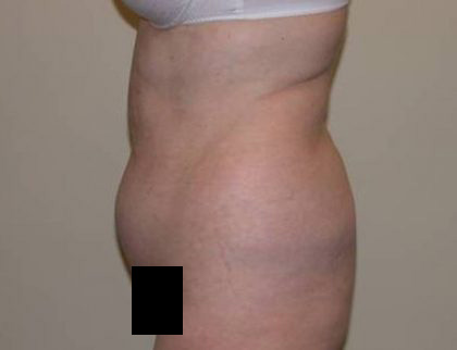 Standard Liposuction Before & After Patient #5327
