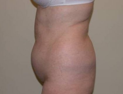 Standard Liposuction Before & After Patient #5327