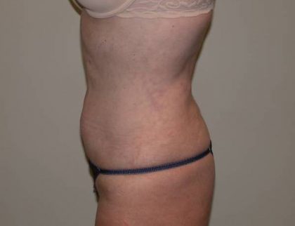 Standard Liposuction Before & After Patient #5327