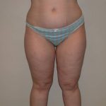 Legs Liposuction Before & After Patient #5335