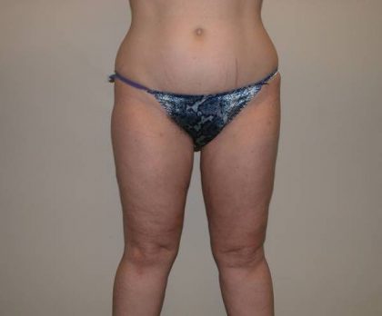 Legs Liposuction Before & After Patient #5335
