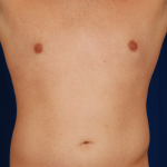 VASER Hi Def Liposuction Before & After Patient #5336