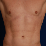 VASER Hi Def Liposuction Before & After Patient #5336