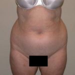 VASER Hi Def Liposuction Before & After Patient #5355