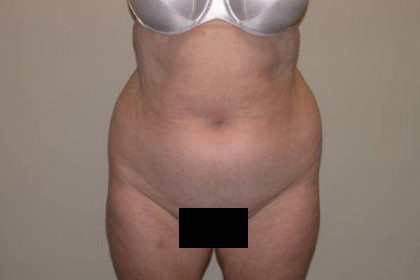 VASER Hi Def Liposuction Before & After Patient #5355