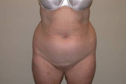 VASER Hi Def Liposuction Before & After Patient #5355