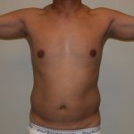 VASER Hi Def Liposuction Before & After Patient #5368