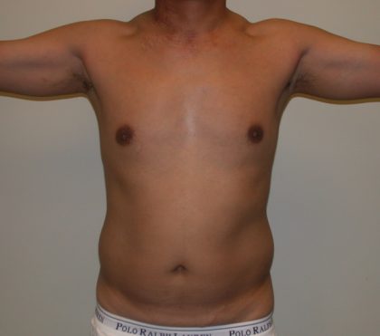 VASER Hi Def Liposuction Before & After Patient #5368