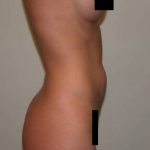 VASER Hi Def Liposuction Before & After Patient #5381
