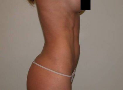 VASER Hi Def Liposuction Before & After Patient #5381