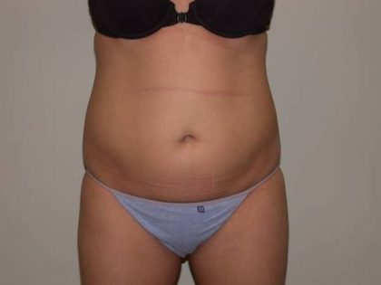VASER Hi Def Liposuction Before & After Patient #5382