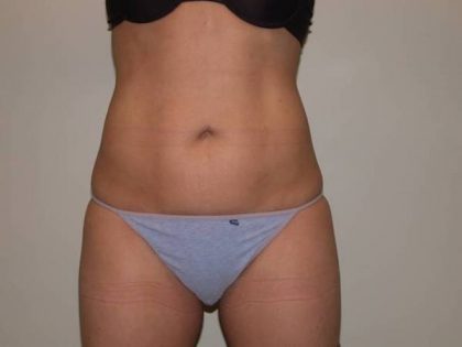 VASER Hi Def Liposuction Before & After Patient #5382