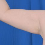 Arms Liposuction Before & After Patient #5439