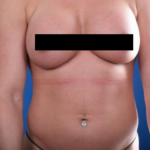 VASER Hi Def Liposuction Before & After Patient #5459