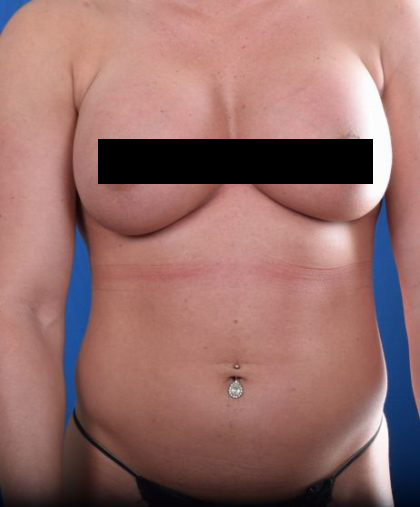 VASER Hi Def Liposuction Before & After Patient #5459