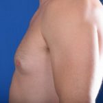 Gynecomastia Before & After Patient #5447