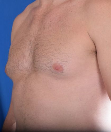 Gynecomastia Before & After Patient #5447