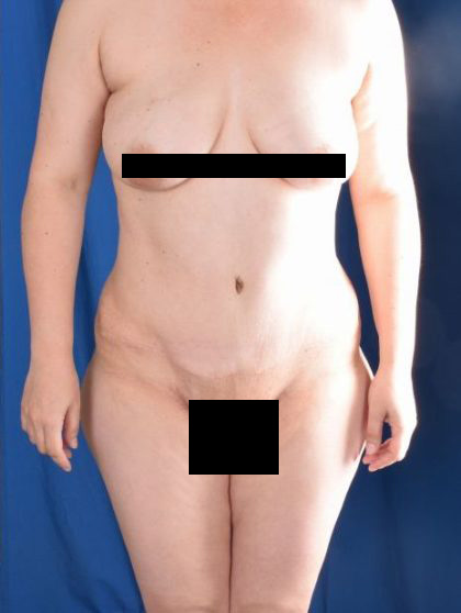 Tummy Tuck Before & After Patient #5452