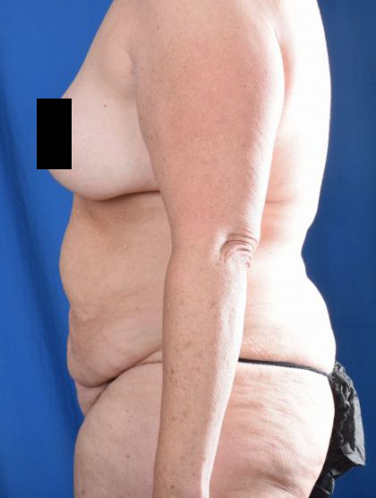 Tummy Tuck Before & After Patient #5475