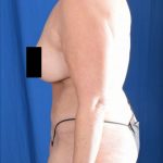 Tummy Tuck Before & After Patient #5475