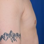 Gynecomastia Before & After Patient #5584