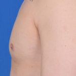 Gynecomastia Before & After Patient #5584