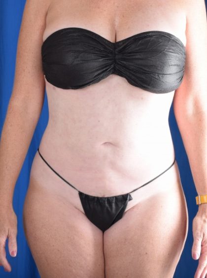 Standard Liposuction Before & After Patient #5592