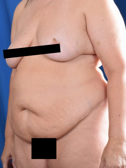 Tummy Tuck Before & After Patient #5606