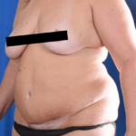 Tummy Tuck Before & After Patient #5606