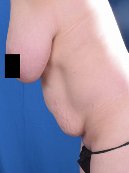 Tummy Tuck Before & After Patient #5609