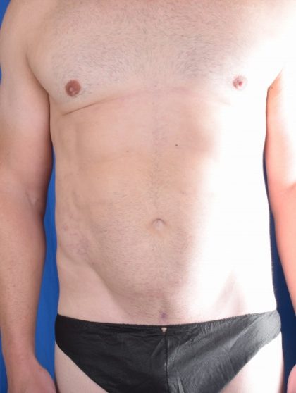 VASER Hi Def Liposuction Before & After Patient #5628
