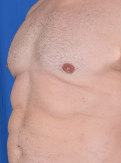 VASER Hi Def Liposuction Before & After Patient #5628