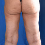 Legs Liposuction Before & After Patient #5695