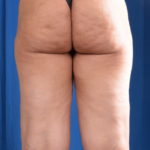 Legs Liposuction Before & After Patient #5695