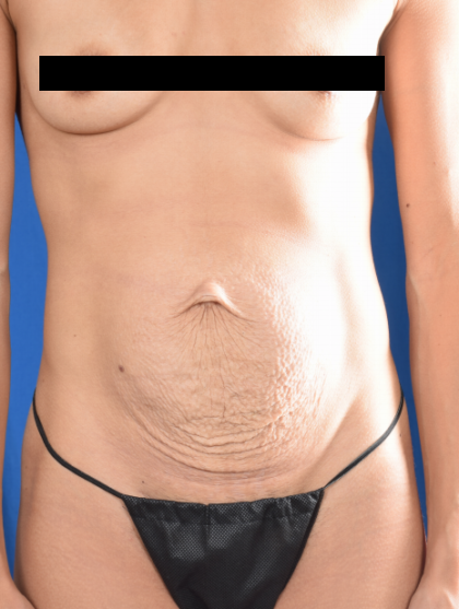 Tummy Tuck Before & After Patient #5670