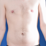 VASER Hi Def Liposuction Before & After Patient #5703