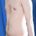 VASER Hi Def Liposuction Before & After Patient #5703