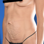 Tummy Tuck Before & After Patient #5670