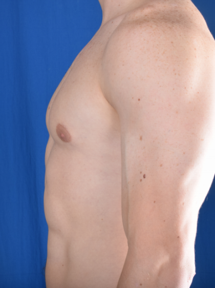 Gynecomastia Before & After Patient #5683