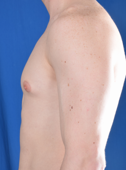 Gynecomastia Before & After Patient #5683